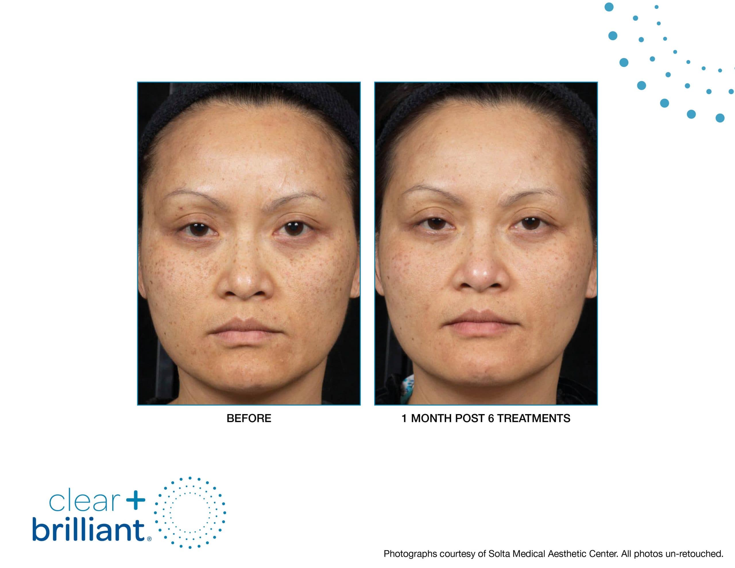 Deluxe Med Spa before and after results at Deluxe Med Spa