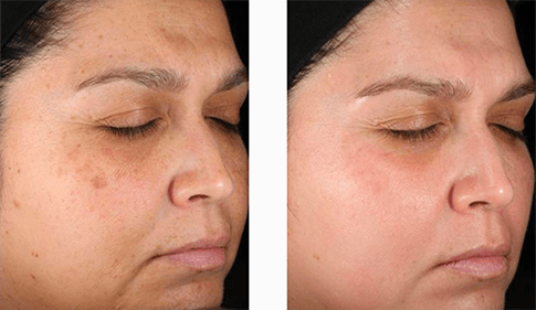 Deluxe Med Spa before and after results at Deluxe Med Spa