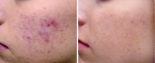 Deluxe Med Spa before and after results at Deluxe Med Spa