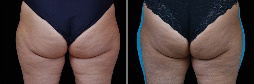 Emsculpt Neo before and after results at Deluxe Med Spa