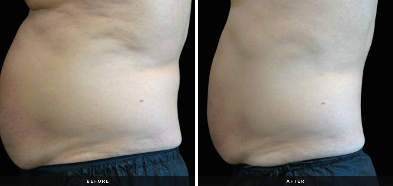 Emsculpt Neo before and after results at Deluxe Med Spa