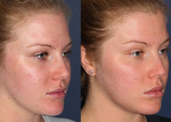 IPL Photofacial before and after results at Deluxe Med Spa
