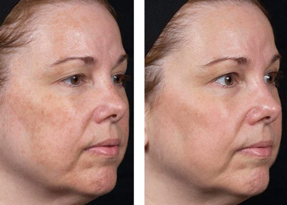 IPL Photofacial before and after results at Deluxe Med Spa