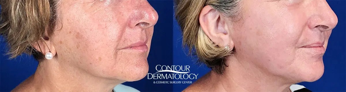 IPL Photofacial before and after results at Deluxe Med Spa