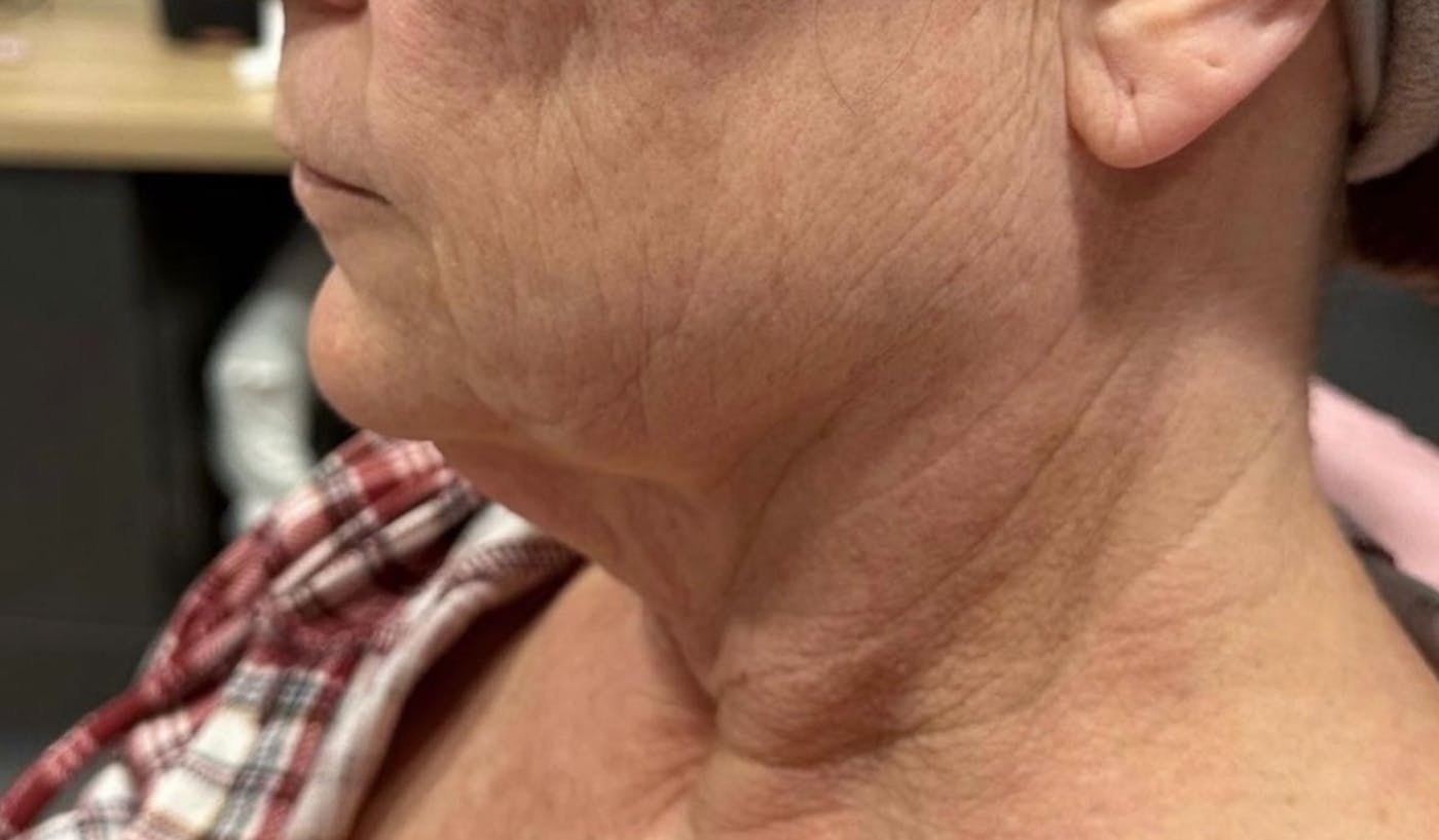 Morpheus8 before and after results at Deluxe Med Spa