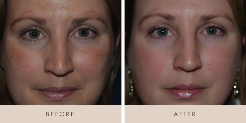 PicoSure before and after results at Deluxe Med Spa