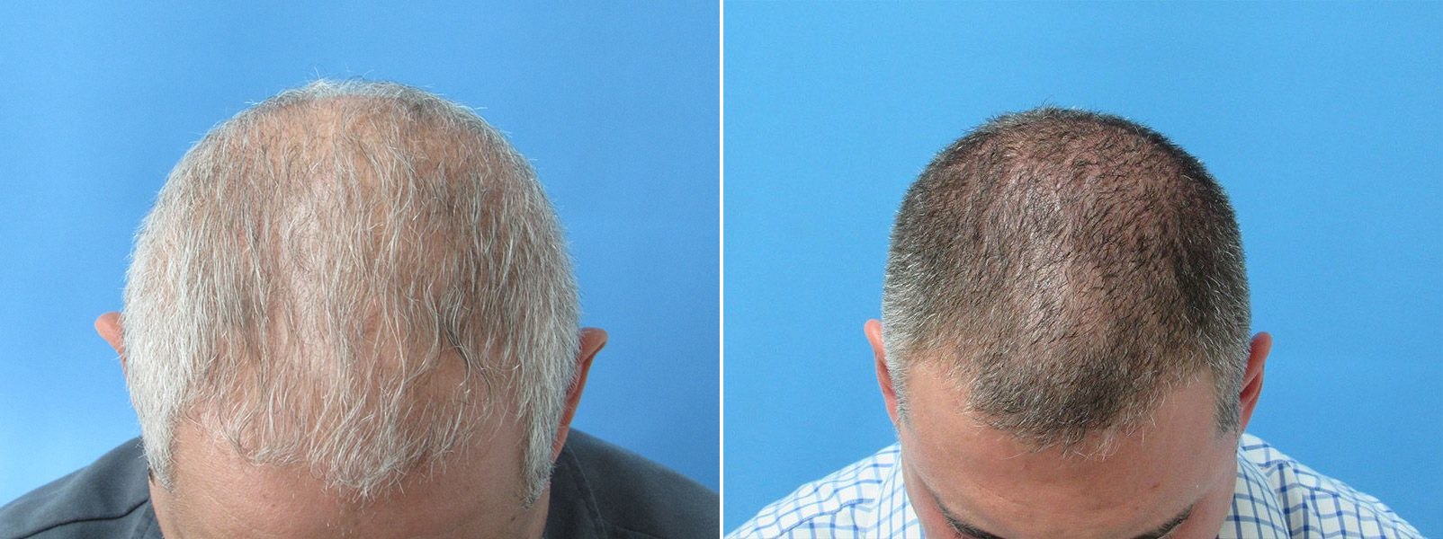 PRP Hair Restoration before and after results at Deluxe Med Spa