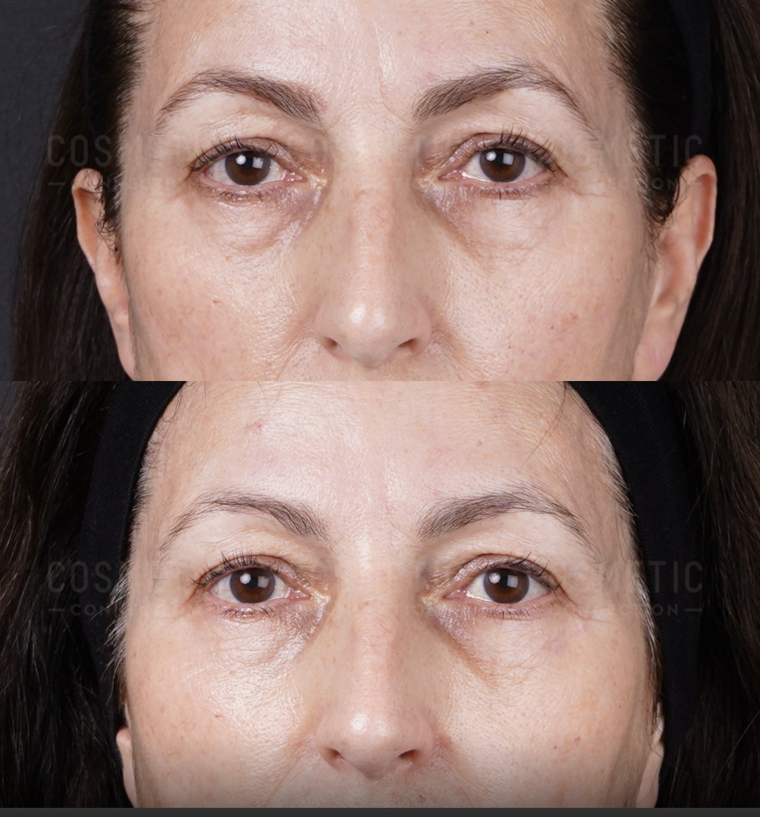 Rejuran before and after results at Deluxe Med Spa