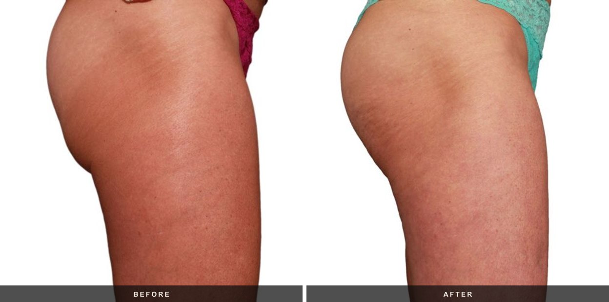 Venus Legacy before and after results at Deluxe Med Spa