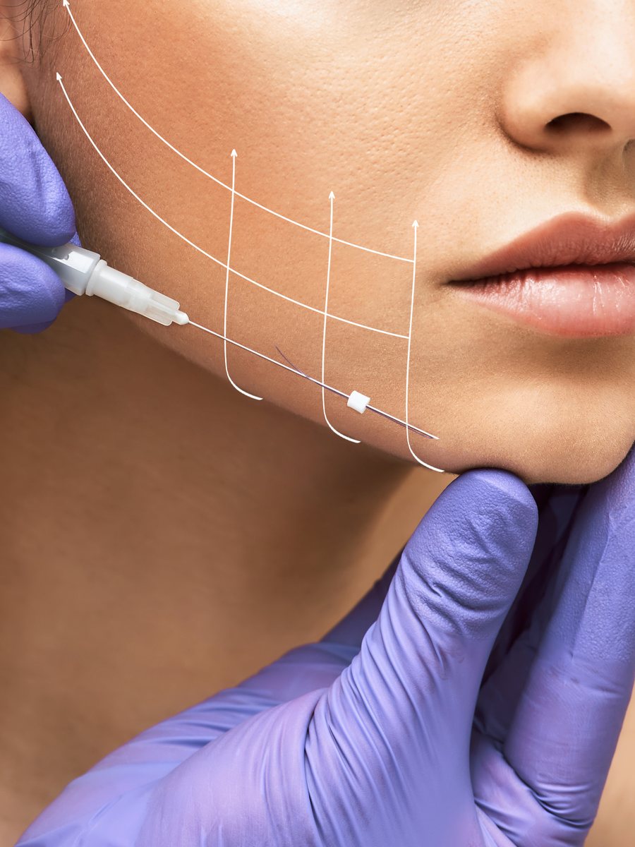 PDO thread lift facial contour mapping